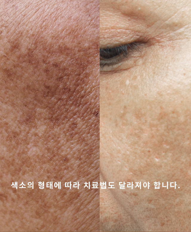 검버섯.베커모반.밀크반점
