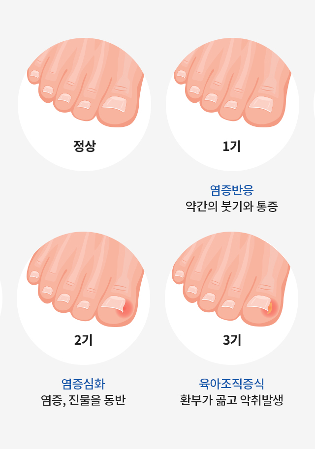 손발톱 무좀